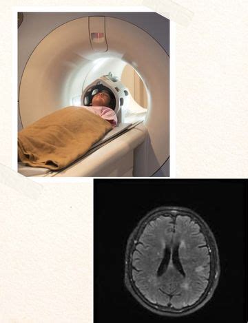 MRI scan for Brain Stroke Protocol | Hyderabad | Medintu