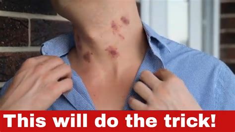 How to Get Rid of Hickeys - 11 Proven Methods to Clear Your Skin Quickly! - YouTube