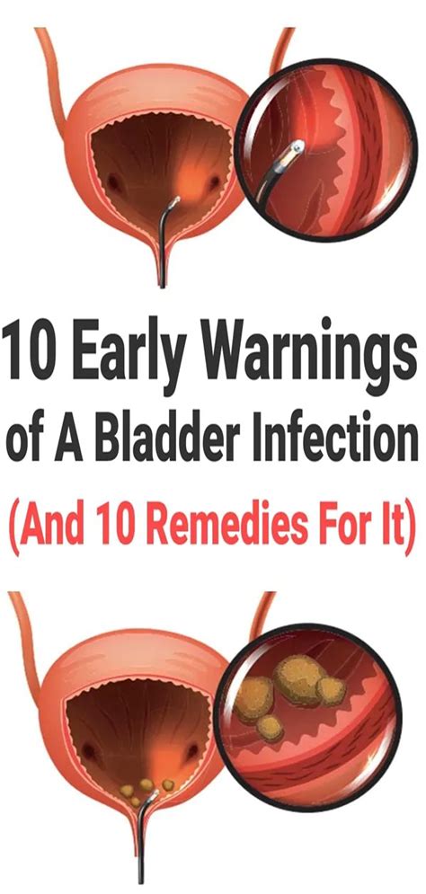 10 Early Warnings Of A Bladder Infection (And 10 Remedies For It) | Urinary tract infection ...