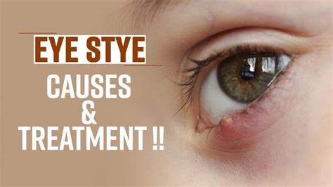 Eye Stye Home Remedies: How To Treat Eye Stye Infection At Home, Watch ...