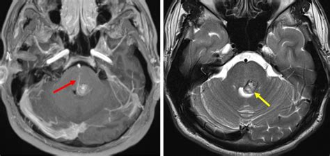 Mixed cerebral vascular malformations – Radiology Cases