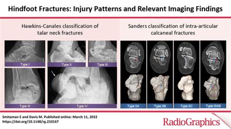 Hindfoot Fractures: Injury Patterns and Relevant Imaging Findings | RadioGraphics