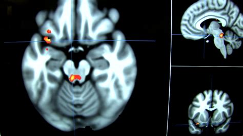 Brain scans may help depression patients find the right treatment | FOX ...