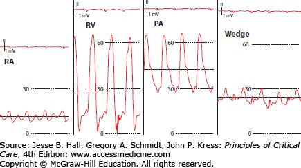 Pulmonary Artery Catheter Waveforms