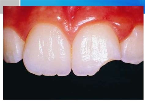 Management of Ellis Class IV Fracture