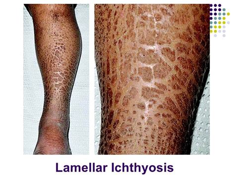 Ichthyoses and Ichthyosiform disorders