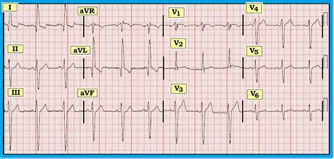 ECG Interpretation: ECG Interpretation Review #45 (IVCD - LAHB ...