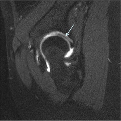 The lateral center-edge angle as radiographic selection criteria for periacetabular osteotomy ...