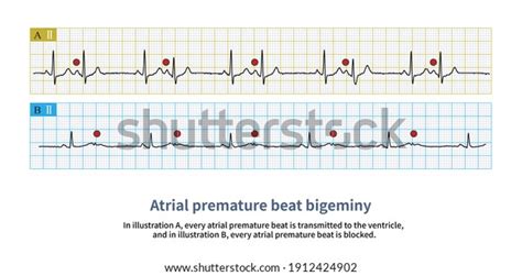 9 Bigeminy Atrial Royalty-Free Images, Stock Photos & Pictures | Shutterstock