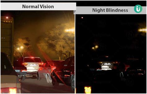 Night Blindness - Symptoms, Causes, Treatment & Prevention - Santripty