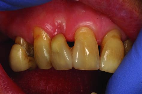 The Finishing and Polishing of Resin Composite Restorations | Pocket ...