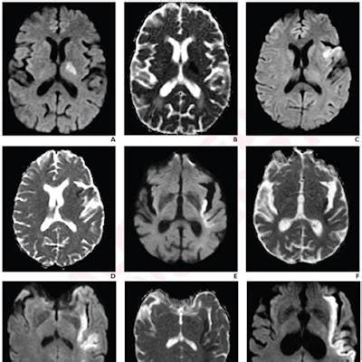 Stroke indicator found on MRI could help with treatment strategies | AuntMinnie