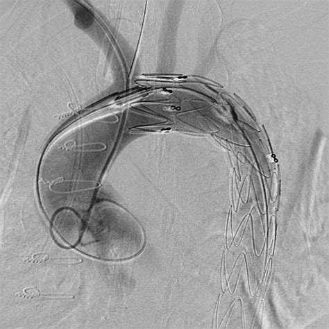 Dissection of descending aorta treated by stent-graft implantation in a patient with Marfan syndrome