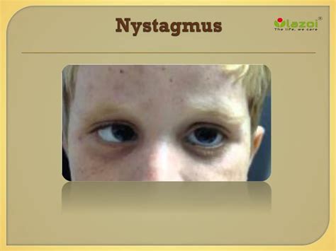 Nystagmus Types Causes Symptoms Diagnosis Treatment Prevention | My XXX Hot Girl