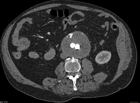 Endovascular Stent Repair of Abdominal Aortic Aneurysm with Endoleak - Vascular Case Studies ...