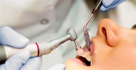 Why Teeth Scaling and Polishing important? - Doctor Monther Numan Dental Clinic