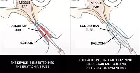 Eustachian Tube Dysfunction | Ear, Nose & Throat Care Center