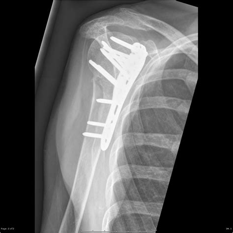 Proximal humerus fracture - wikidoc