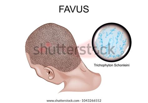 Vector Illustration Favus Fungal Infection Skin Stock Vector (Royalty ...