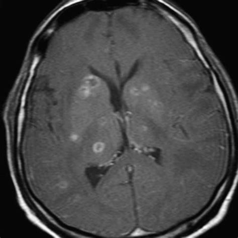 Enhanced T1-weighted MRI. There are numerous, small, ring-enhancing... | Download Scientific Diagram