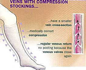 Varicose Veins Compression Stockings | Info and More about our Vein Specialties in St. Louis