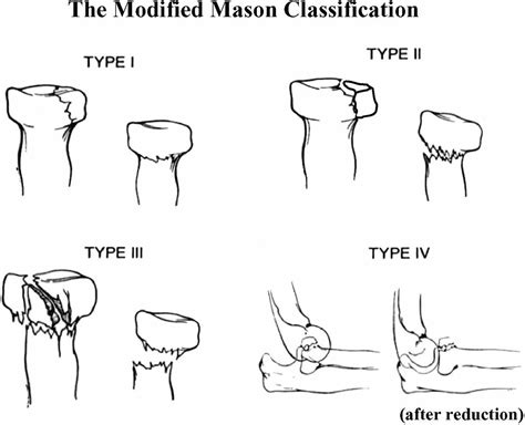 Radial head fracture causes, types, symptoms, diagnosis, treatment ...