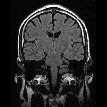 MRI Images - Brain MRI Coronal FLAIR 001 - MR-TIP.com