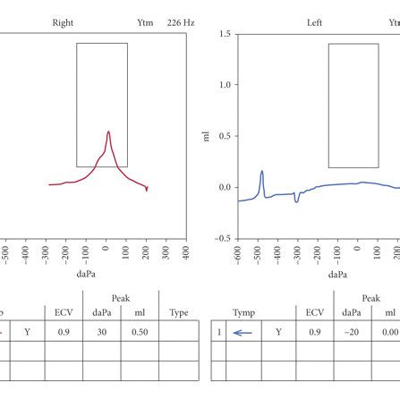 Tympanogram showing type A for the right ear and type B for the left ear. | Download Scientific ...