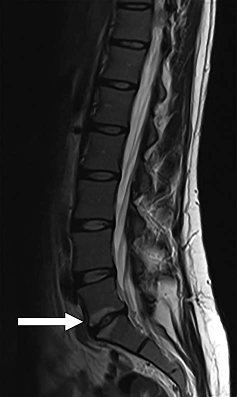 Modic Type 1 Vertebral Endplate Changes: Injury, Inflammation, or Infection? | AJR