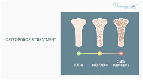 Osteoporosis Treatment Cost In India | Procedure | Medsurge Inida