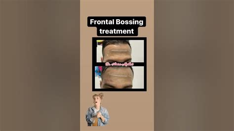 Frontal Bossing treatment - YouTube