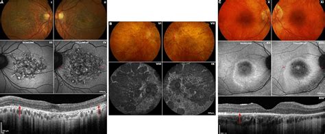 Progressive cone and cone-rod dystrophies: clinical features, molecular genetics and prospects ...