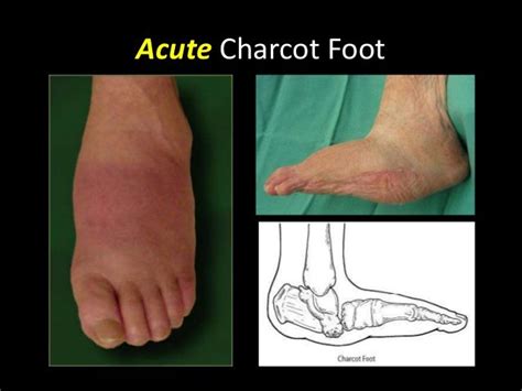 Charcot foot