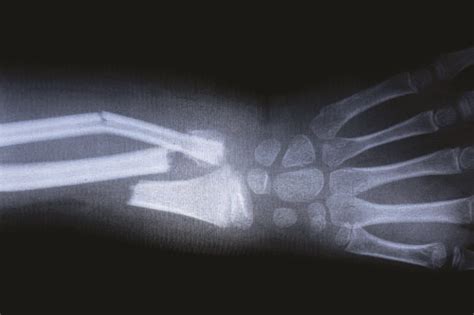 Treating broken bones | 2019-12-29 | Safety+Health Magazine