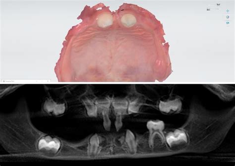 Dental Treatment of Ectodermal Dysplasia