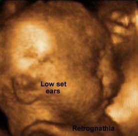 Trisomy 18 Ultrasound