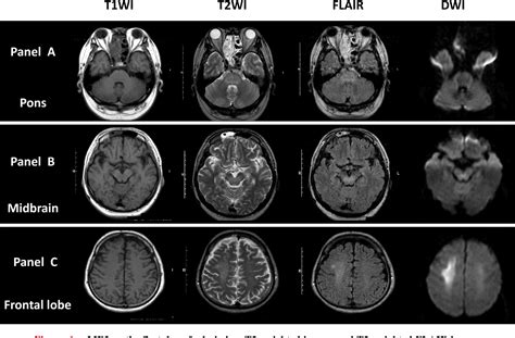 Figure 1 from Posterior Reversible Encephalopathy Syndrome in a Patient with Severe Uremia ...