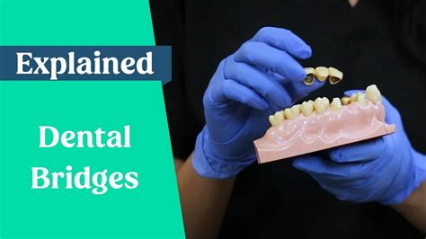 Dental bridges explained (False teeth alternative) - YouTube