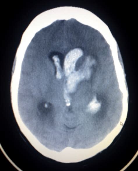 Stroke Classification | Bamford | Oxford | Geeky Medics