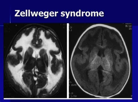 Zellweger Syndrome | CheckRare