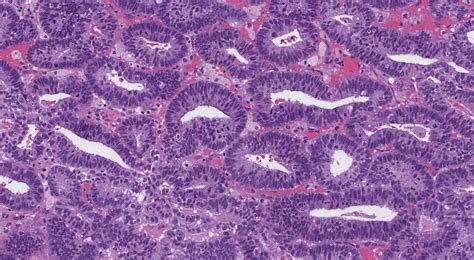 Endometrial endometrioid adenocarcinoma | MyPathologyReport.ca