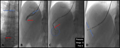 Major Haemorrhage Following a Transjugular Liver Biopsy: A Case Report and a Discussion of ...