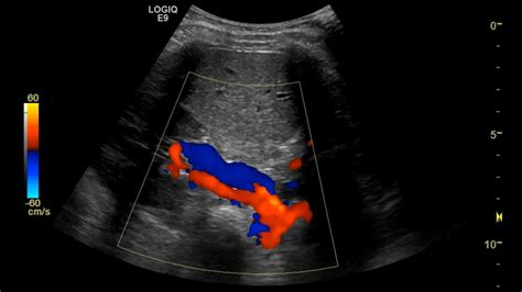 Renal Artery Doppler – Sonographic Tendencies