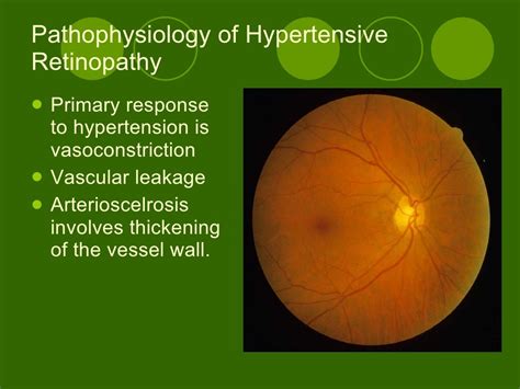 Hypertensive Retinopathy