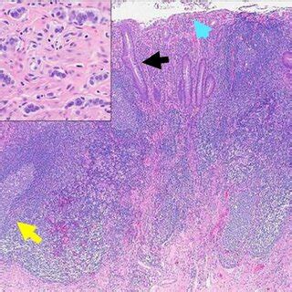 Sigmoid colon histology showing neuroendocrine cell proliferation ...