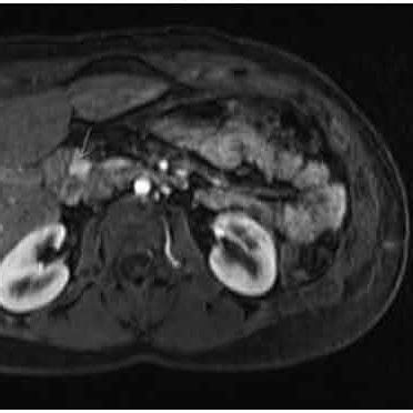 MRI showing the recurrence at pancreatic head. | Download Scientific ...