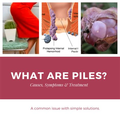 What Are Piles? Causes and Treatment - HealthProAdvice