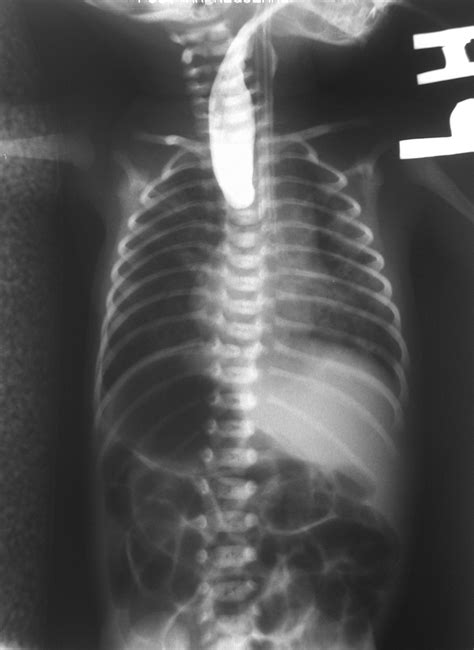 Esophageal atresia - Wikipedia