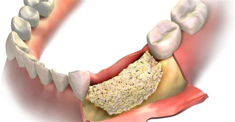 Bone Graft Tooth Extraction, What It Is And Recovery Time | Suburban Essex