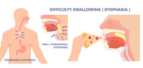 DIFFICULTY IN SWALLOWING (DYSPHAGIA) | Research Library | OMI Hospital